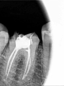 My tooth, sans roots.